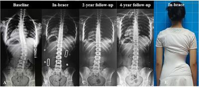 Comparison of the efficacy of thoracolumbosacral and lumbosacral orthosis for adolescent idiopathic scoliosis in patients with major thoracolumbar or lumbar curves: a prospective controlled study